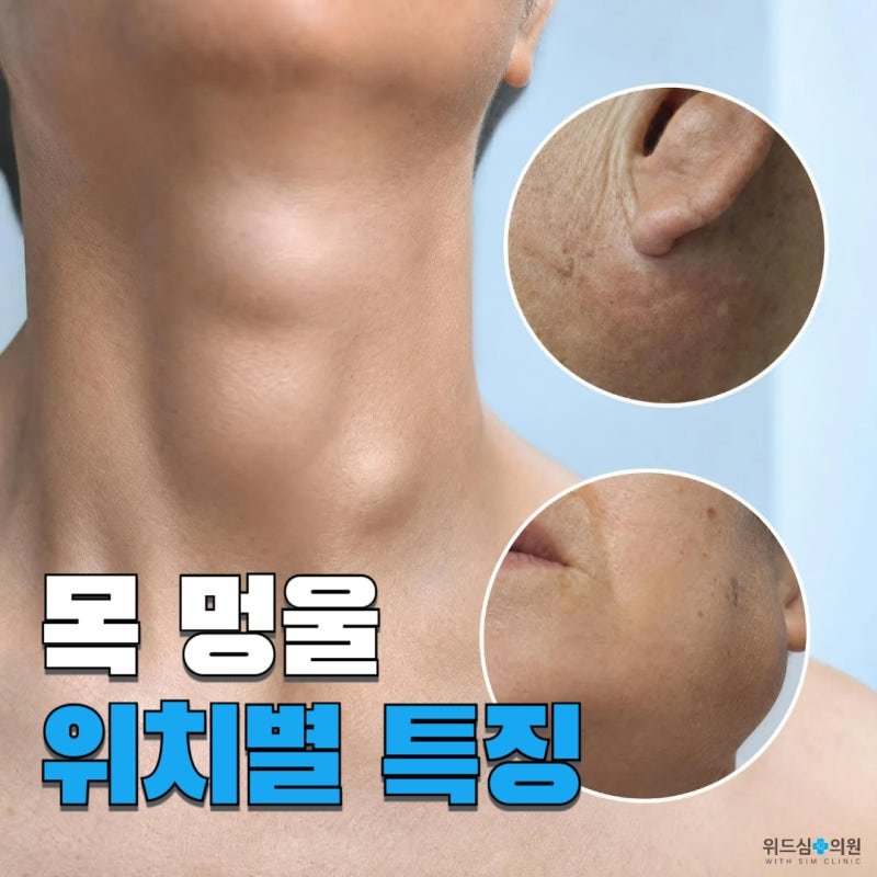 목에 만져지는 멍울, 갑상선암·임파선암·침샘암 어떻게 구별하고 진단할까요? :: 위드심의....