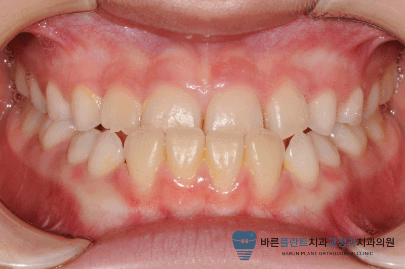 금광동 치과 반대교합 교정 후기 케이스