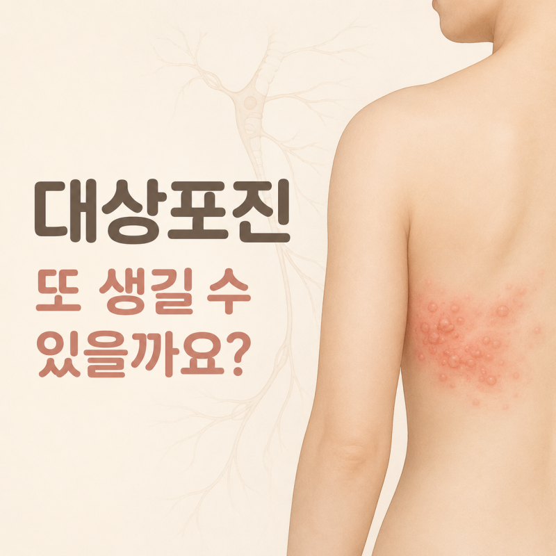 대상포진은 한 번 걸리면 다시 안 걸리나요? 재발할 수도 있을까요?