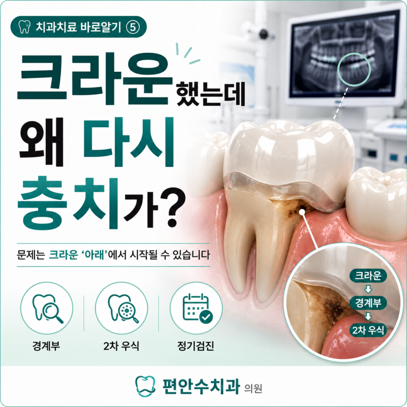 크라운 했는데 왜 다시 충치가 생길까요?씌운 치아도 충치가 생길 수 있는 이유 상인동 치과 ....