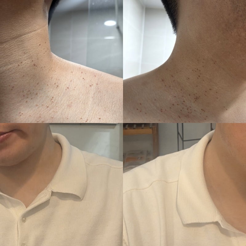 부산 서면 편평사마귀 제거 목 얼굴 무제한 시술 후기