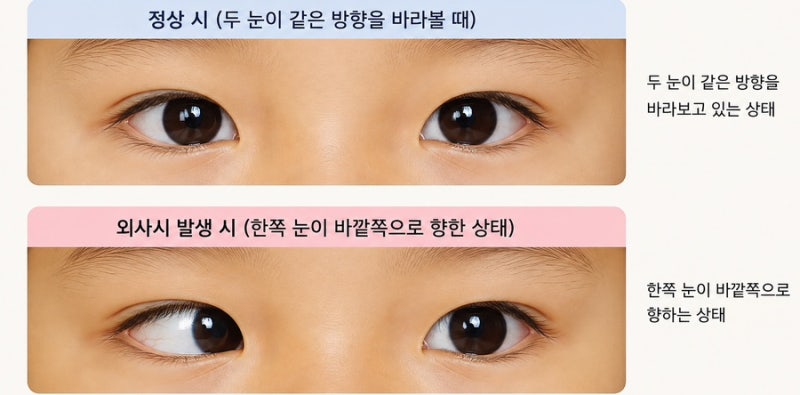 돌 무렵 발견한 우리 아이 간헐적 외사시, 6살 칠곡경북대학병원 진료 후기와 가림치료 이야....