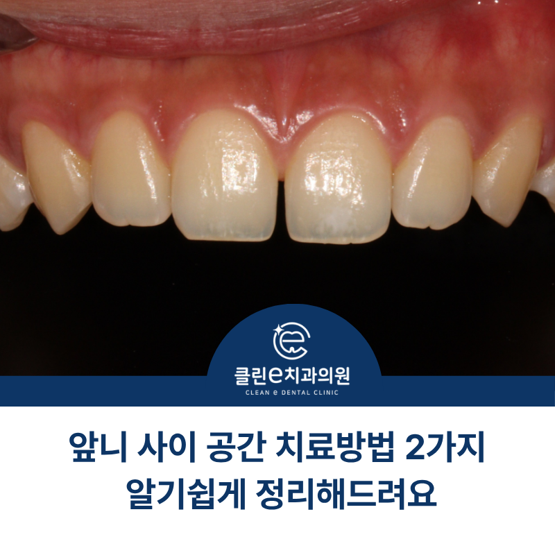 벌어진 앞니 치료는 레진? 라미네이트? 한눈에 정리 마천동치과