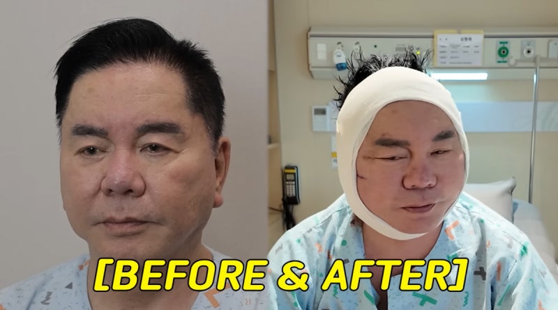 67세 심형래 얼굴에 무슨 일이? 안면거상 결심한 이유