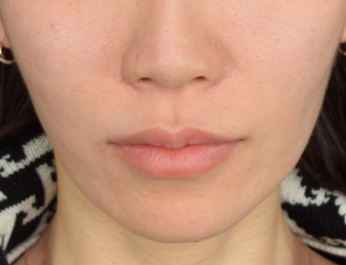 풀페이스 스킨보톡스 후기, 효과가 있을까? 모공·잔주름·피부결 변화 정리