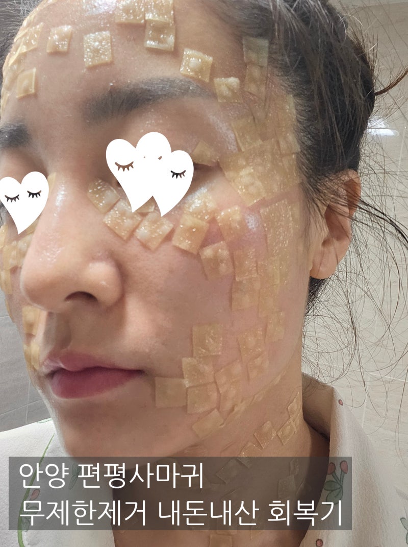 2탄 리얼내돈내산 안양 편평사마귀 성지 제거후기 듀오덤 전쟁 재생크림 떡칠 자외선차단 마....