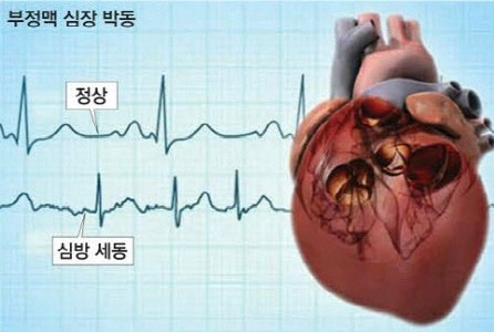 ‘조용한 심방세동’ 증상이 없는데도 뇌경색이 먼저 나타날 수 있다
