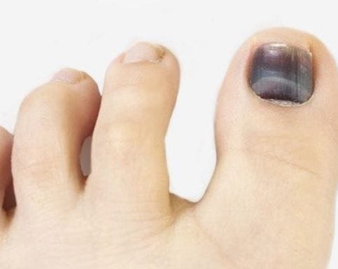 “어디 부딪힌 적도 없는데 발톱이 검어졌다” 엄지발가락 검은 발톱에서 확인해야 할 원인....