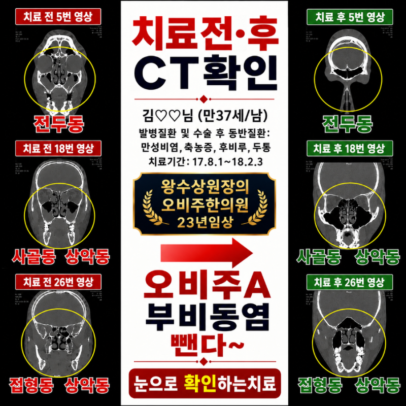 기침 콧물 후비루 코막힘 두통 중이염 고열 잦은감기, 축농증(부비동염) 만성비염 질환이 치....