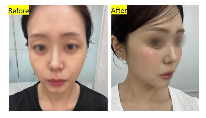 신사역 피부과 세르프300샷 고주파 리프팅 효과 및 가격 솔직후기