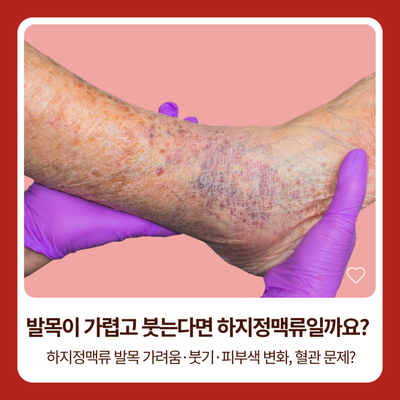 하지정맥류 증상, 발목 가려움과 피부색 변화도 나타날 수 있나요? | 불광역 혈관외과