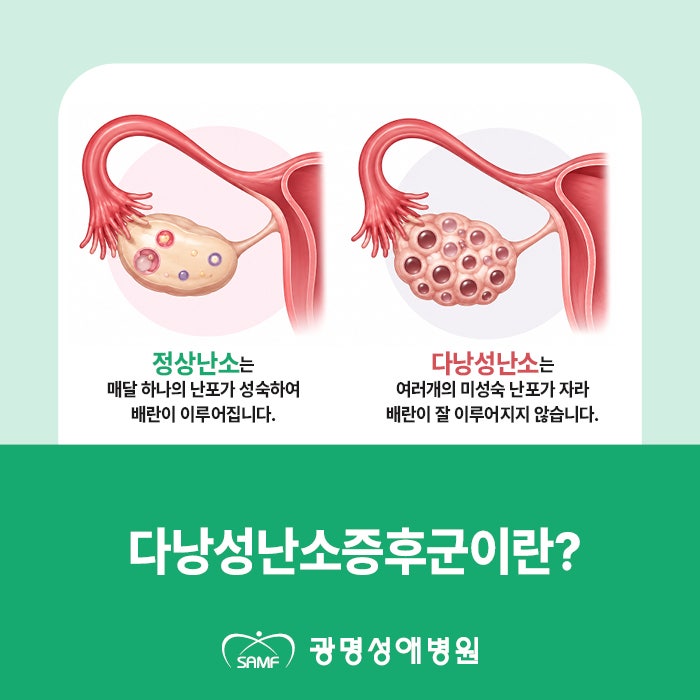 생리가 불규칙하다면? 다낭성난소증후군 증상부터 진단까지