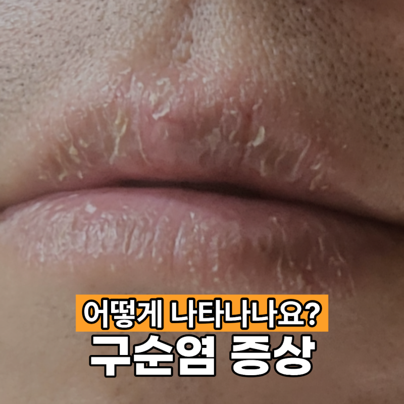구순염 증상 어떻게 나타날까요?