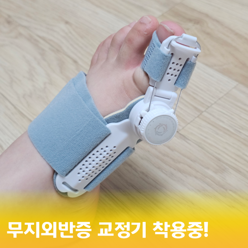 효과 있을까? 엄지발가락 휨 때문에 써본 발가락교정기 무지외반증교정기 매일 착용해 본 느....