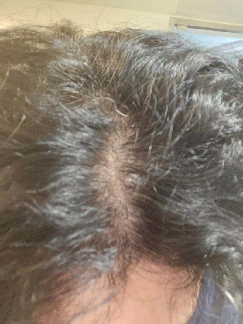 트리코닉스 탈모샴푸 내돈내산 일주일 사용후기 두번째 기록 (첫사용 : 260819)