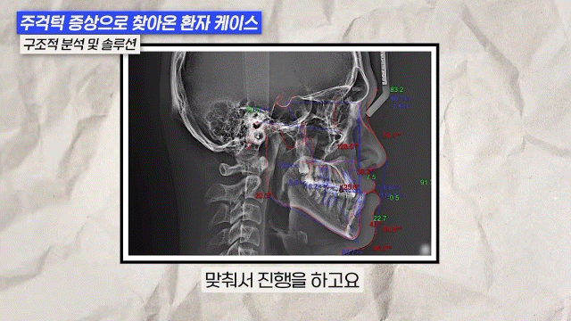 비수술주걱턱교정, 양악수술없이 교정 가능할까요?