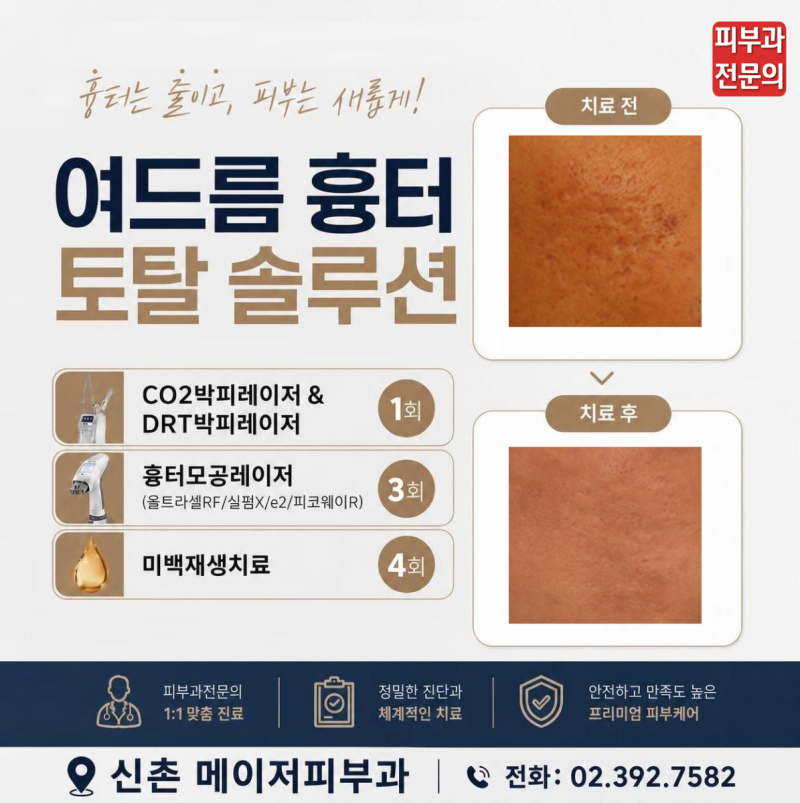 여드름 흉터 레이저 치료, 가격,효과,비용,이벤트, 프락셀·CO₂박피레이저·DRT 진피재생술·....