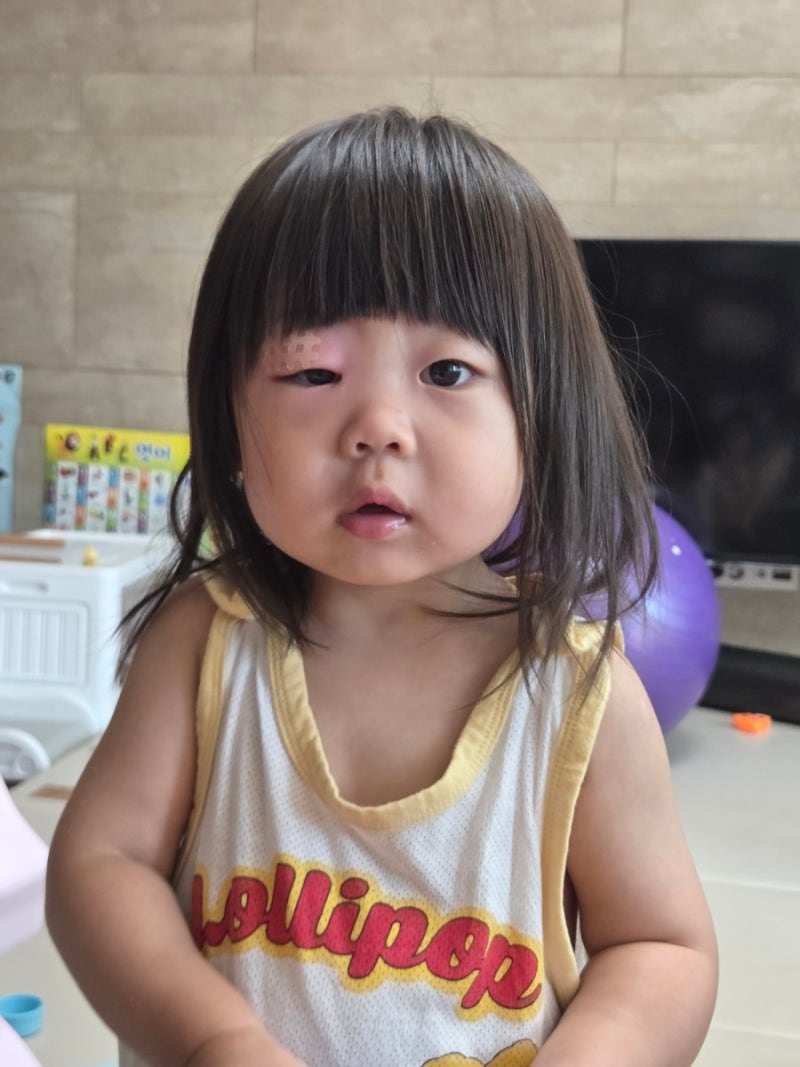 아기 모기 물렸는데 항생제까지?눈두덩이 부음 열나서 병원 간 후기