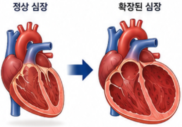 [성인간호학] 115. 심근병증(Cardiomyopathy)의 종류와 주요 증상