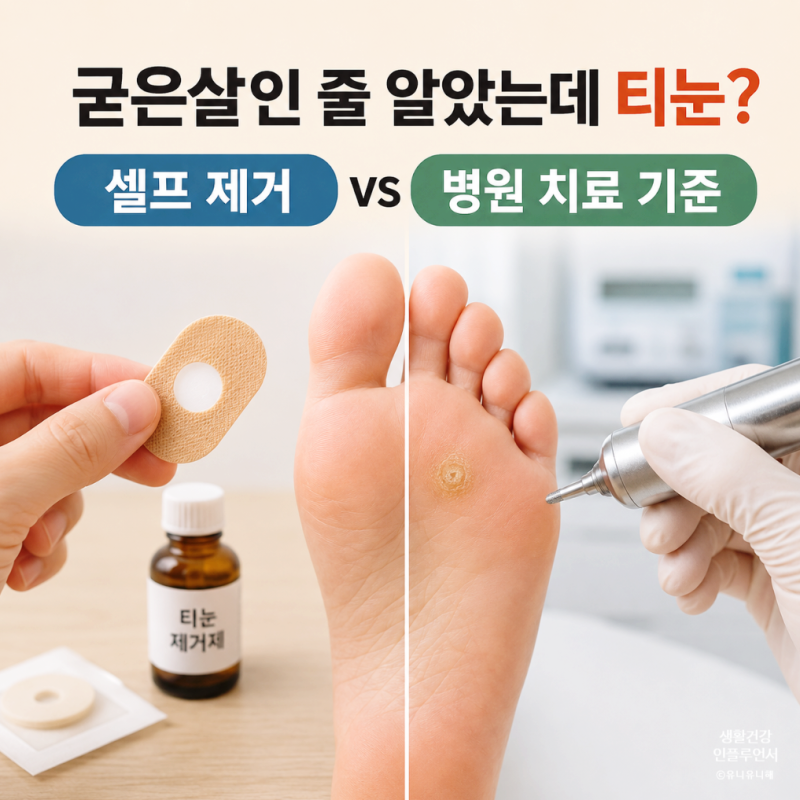 발바닥 티눈 제거 방법, 밴드와 약으로 될까? 병원 가야 하는 경우 정리
