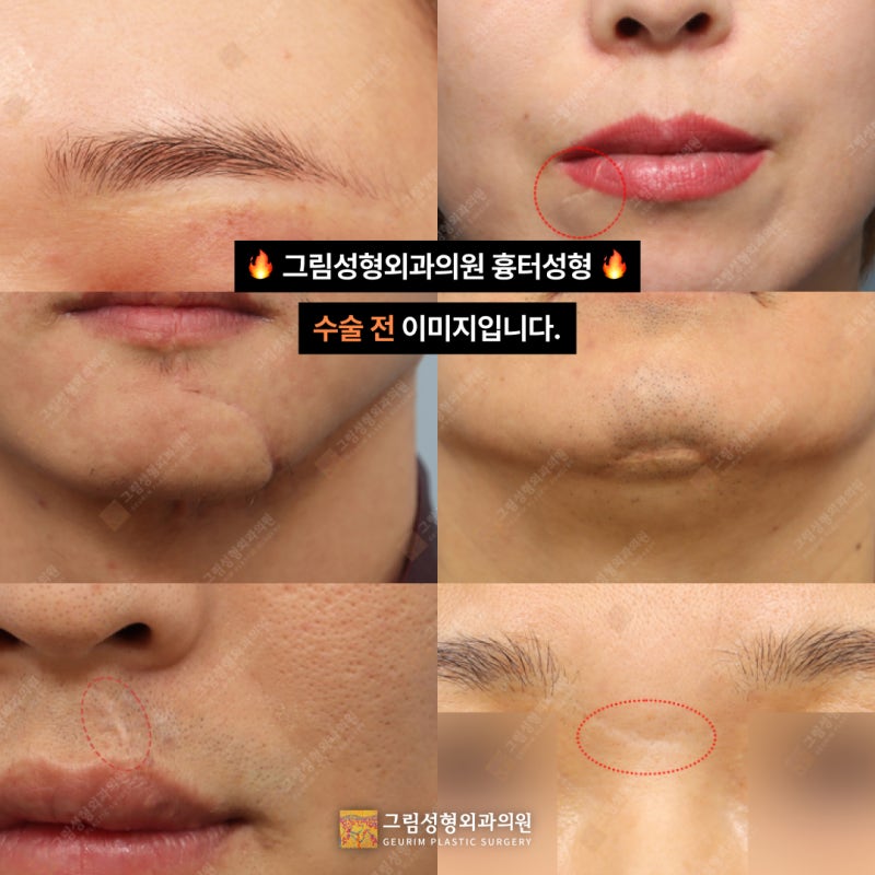 흉터 치료 병원 방문 전 확인해야 할 3가지