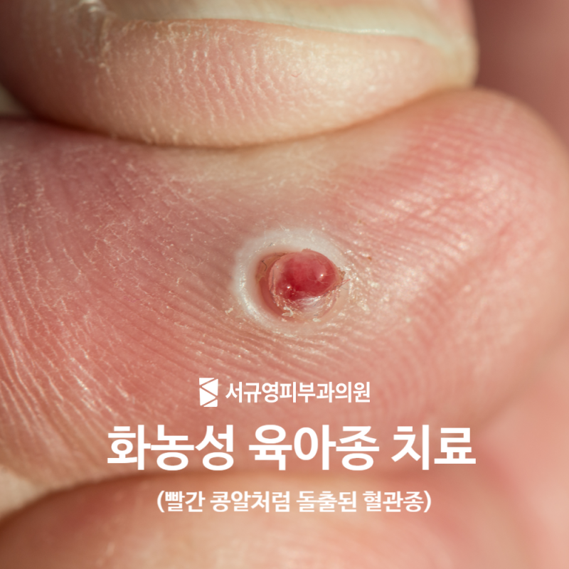 구미피부과 화농성육아종 손가락 혈관종 레이저 치료