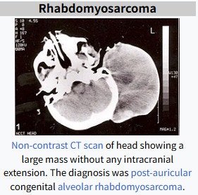 rhabdomyosarcoma(횡문근육종)