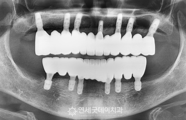 야탑역치과 40대 임플란트 종류 (스트라우만, 오스템, 덴티움)