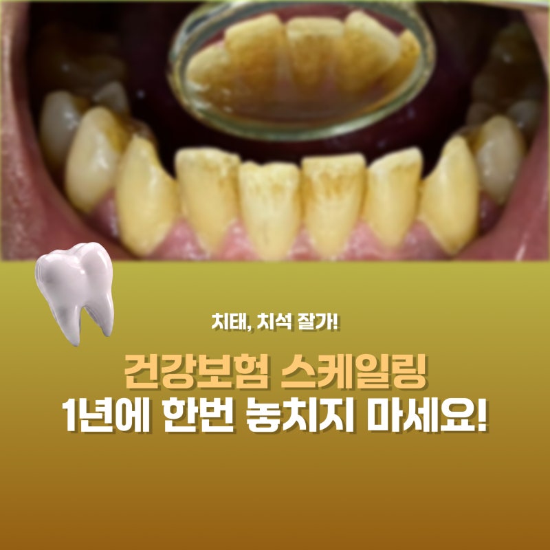 건강보험 스케일링 1년에 한번 놓치지 마세요! 오금동 치과 에서 안내해 드립니다.