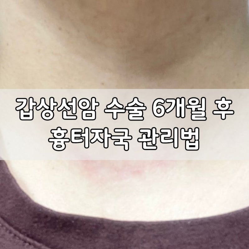 갑상선암 수술 6개월후 흉터자국 관리법