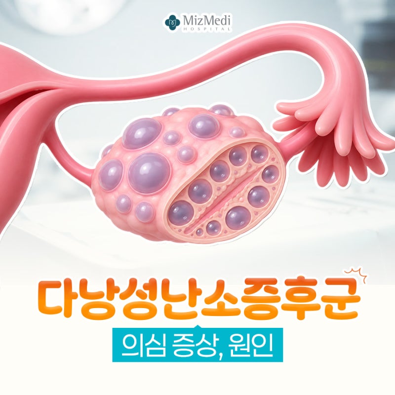강서 산부인과 추천 다낭성난소증후군 의심 증상, 원인