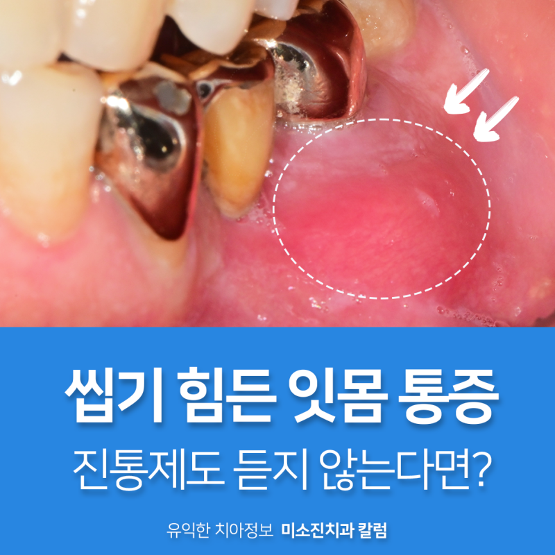 급성 잇몸 염증 및 고름 통증까지 있다면?