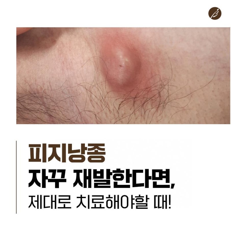 얼굴 피지낭종, 여드름처럼 보여도 함부로 짜면 안 되는 이유는?
