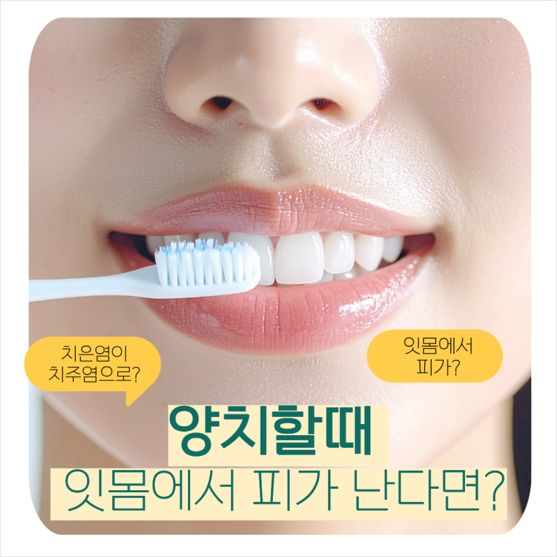 수원치과 치은염이 치주염으로 잇몸에서 피날때 그냥 넘기지 마세요
