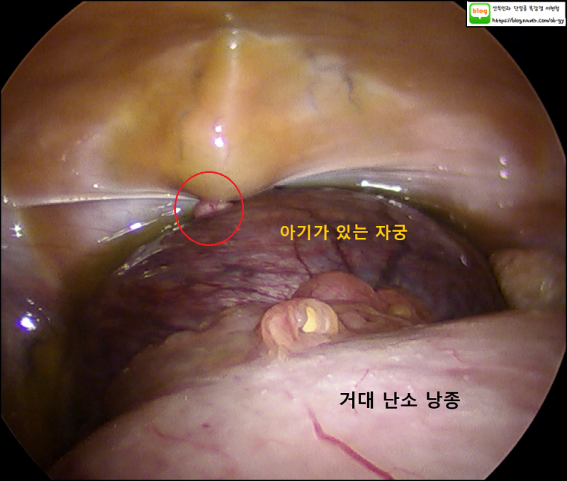 임신 중 갑자기 커진 난소 낭종 : 심한 통증, 단일공 응급 난소 낭종 절제술