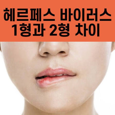 헤르페스 2형 증상, 물집 없으면 괜찮을까? 무증상 감염도 많습니다