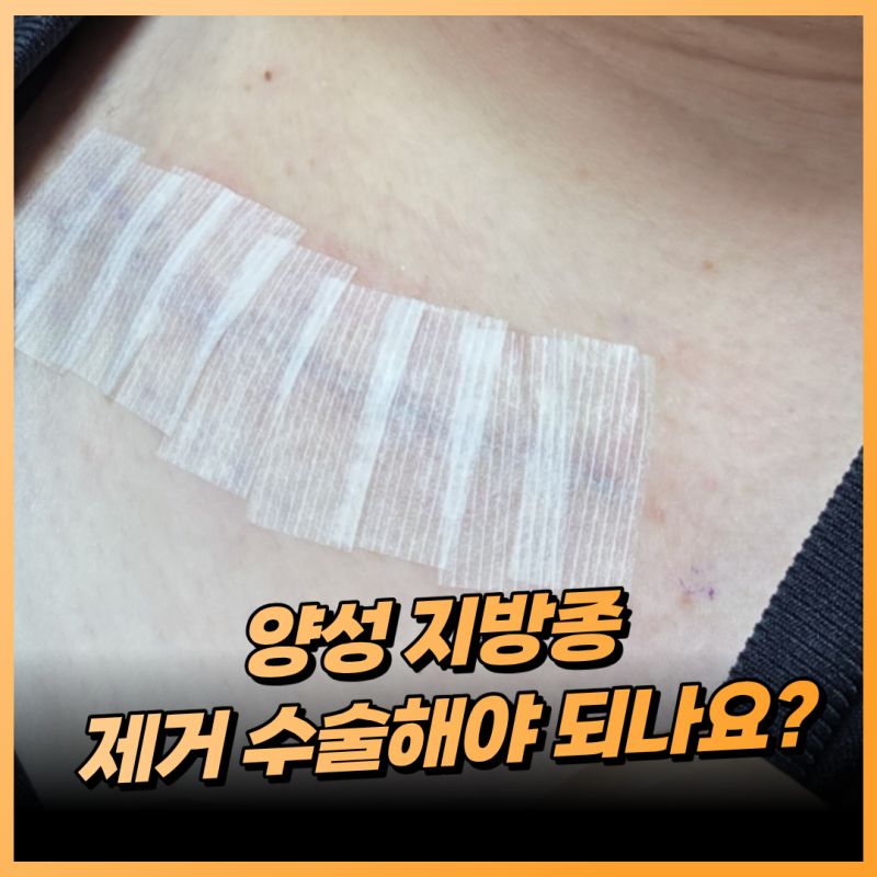 양성 지방종 제거 수술해야 되나요?