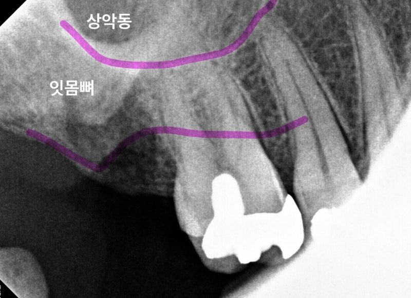 어금니 잇몸 부음, 안쪽 쑤시는 통증 있던 분의 임플란트 사례 소개 - 치과 의사 작성