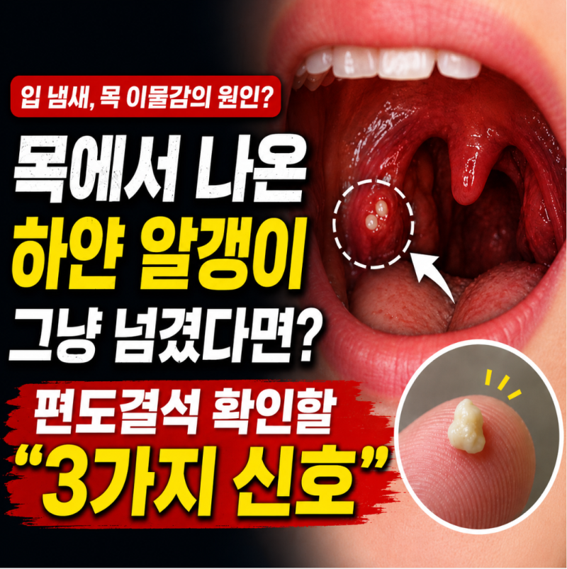 목에서 나온 하얀 알갱이 그냥 넘겼다면? 편도결석 확인할 "3가지 신호"