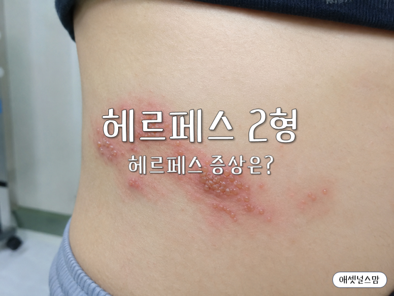 헤르페스 2형 증상, 성기 주변 물집만 보고 넘기면 안 되는 이유