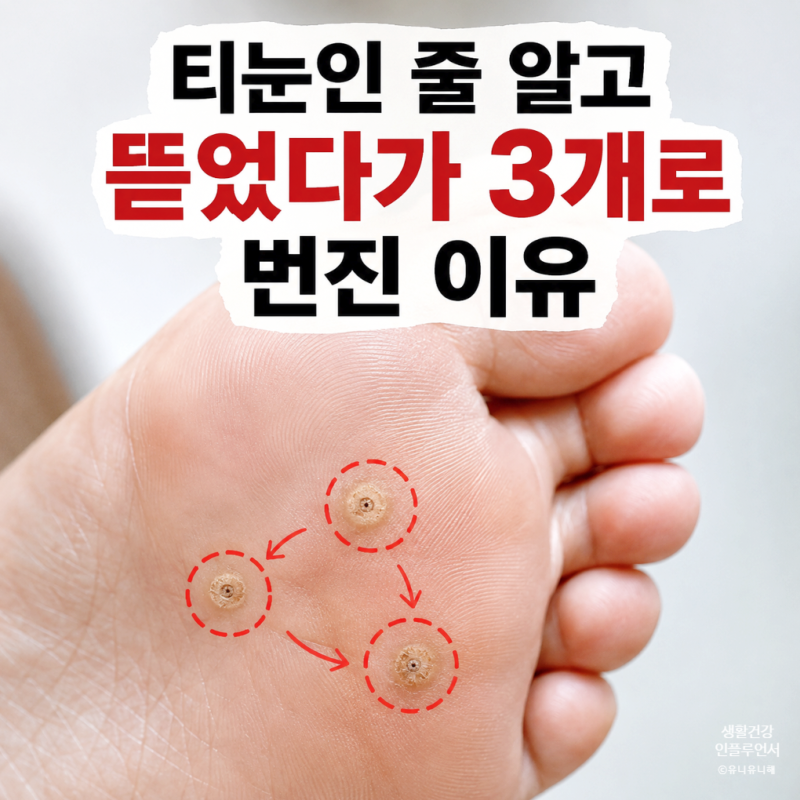 발바닥 티눈 제거 후 번진다면? 사마귀 티눈 차이, 초기 증상 및 원인