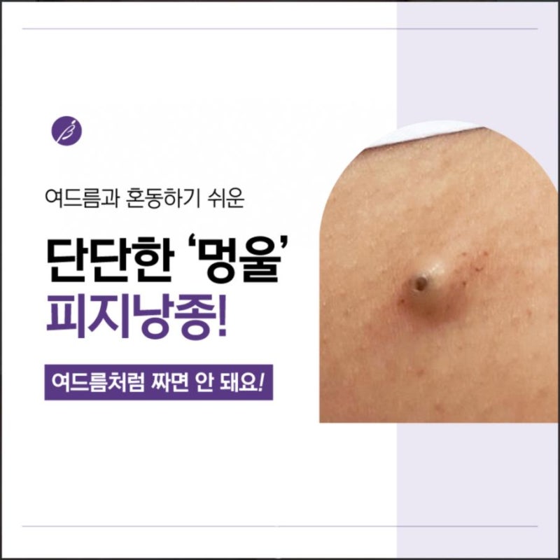 겨드랑이 피지낭종, 아프지 않은 멍울도 방치하면 커질까요?