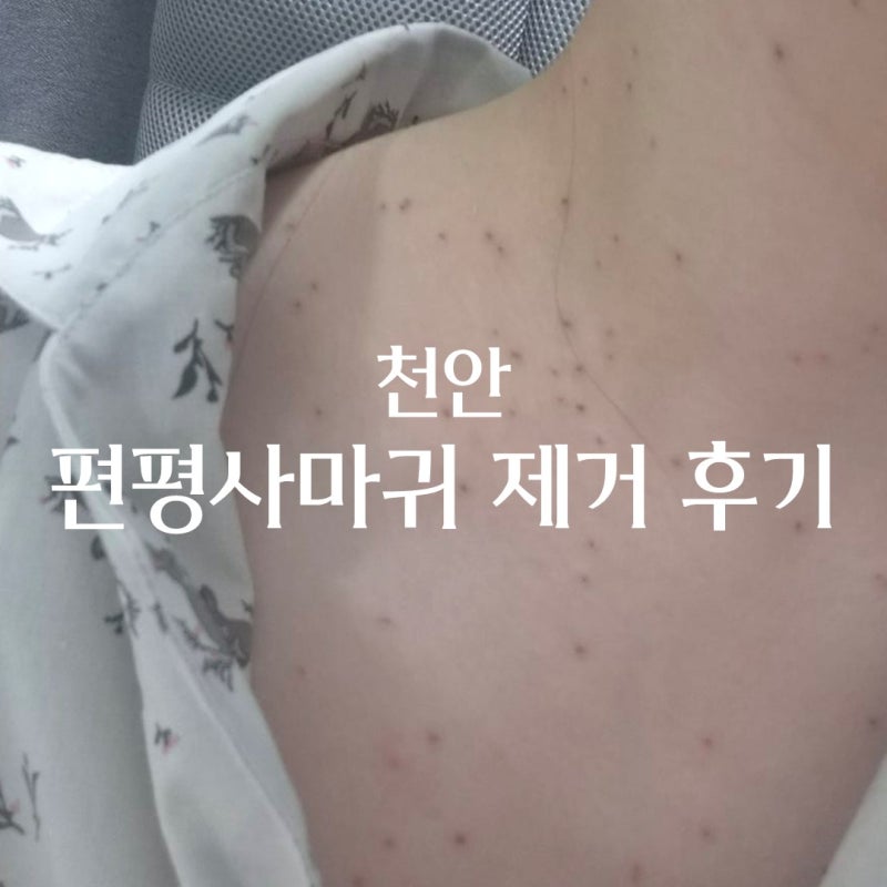 천안 편평사마귀 제거, 실비처리, co2레이저 / 어븀야그 레이저 모두 경험한 후기