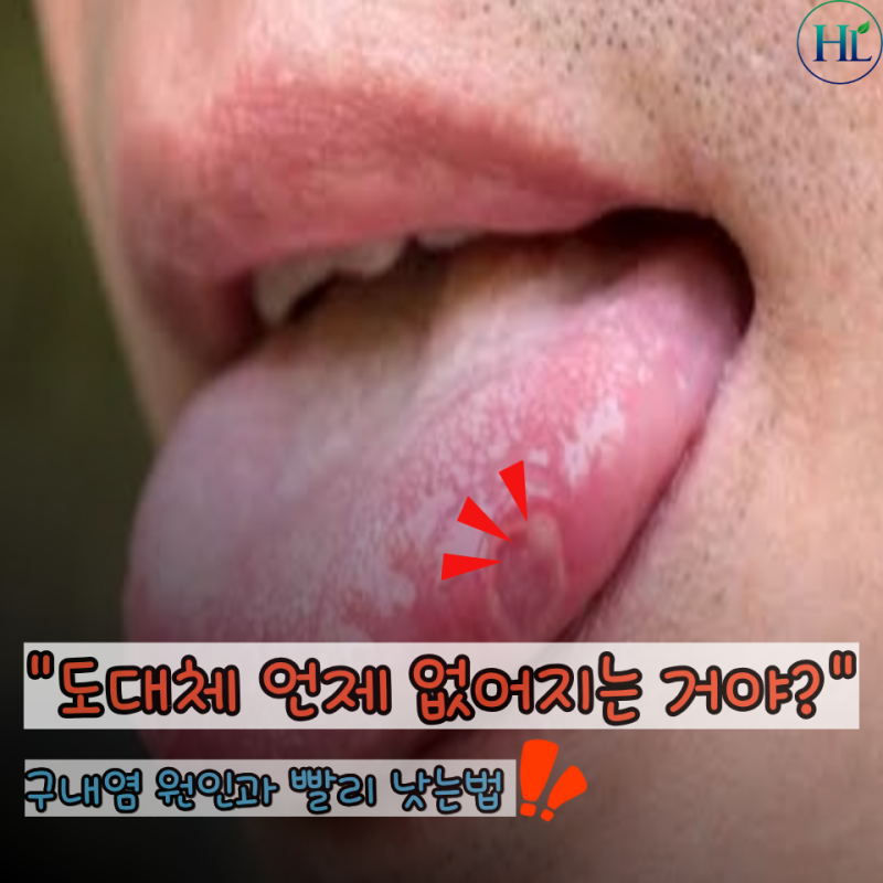 "약 바를까 버텨볼까?" 구내염 원인과 빨리 낫는법 알아보니