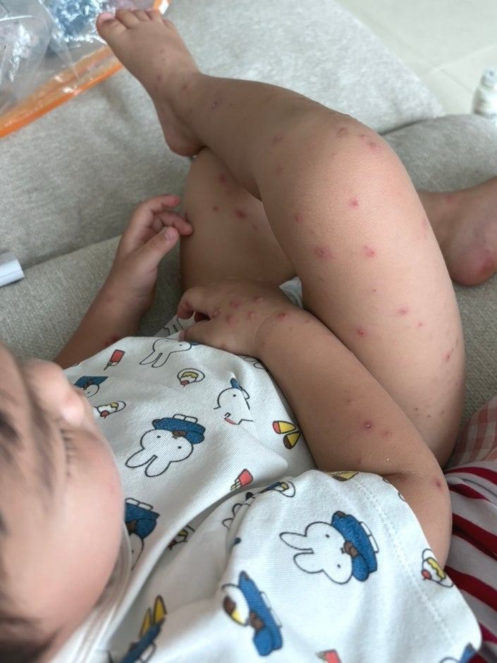 21개월 아기 수족구 두 번째 감염｜증상부터 완치까지 일주일 기록 ,,