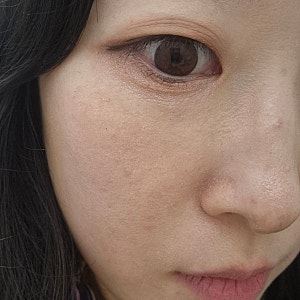 스킨보톡스 3cc(50유닛) 10일차 후기 : 멍, 부작용, 40살 후기