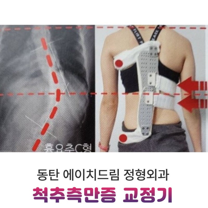 척추측만증 교정기 꼭 해야 할까? 경과관찰·운동·보조기 판단 기준