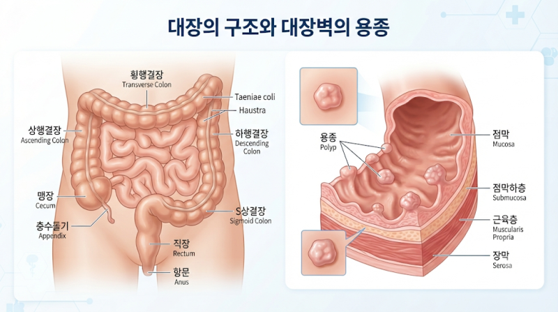 대장용종 증상, 발견됐다면 무조건 제거해야 할까? 제거부터 추적검사까지