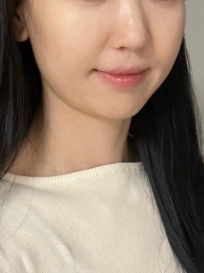 교대역 사각턱보톡스 효과, 침샘보톡스 전후 솔직 후기