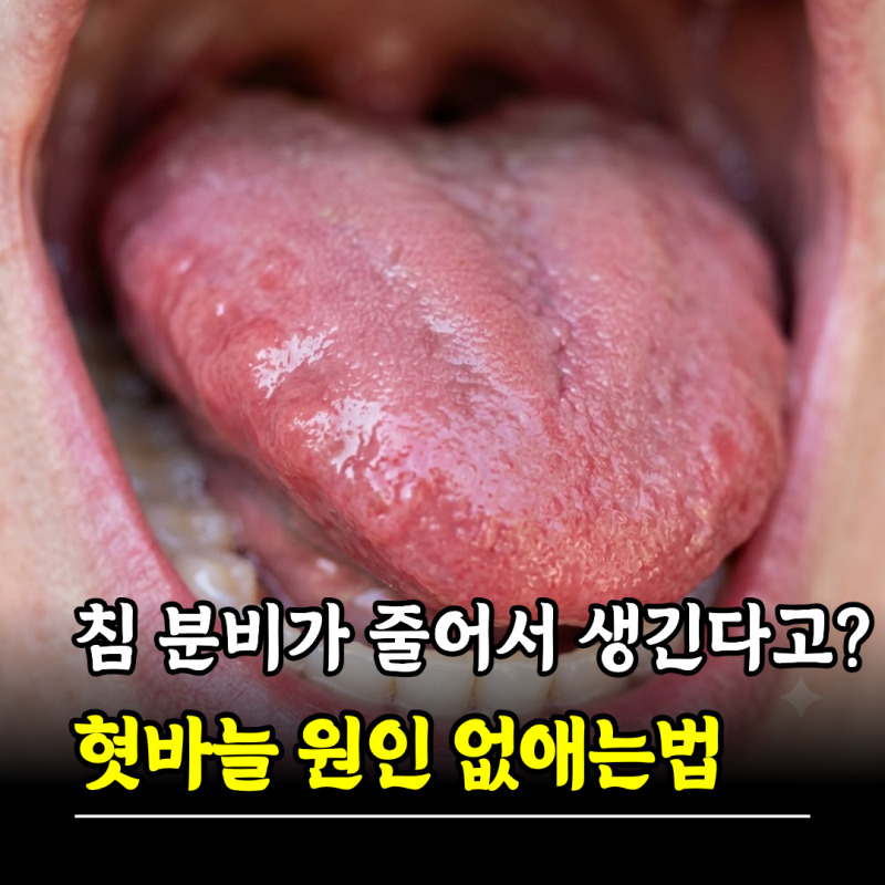 침 분비가 줄어서 생긴다고? 혓바늘 원인 없애는법 약 알보칠